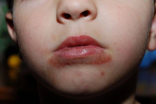 L'eruzione alla bocca del bambino: quali malattie lo causano?