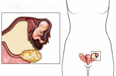 Operazione per rimuovere la cisti ovarica
